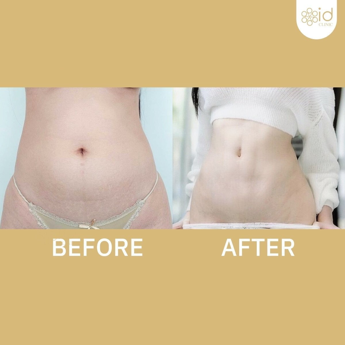 Before and after abdominal liposuction results at ID Clinic Bangkok, slimmer waist contour