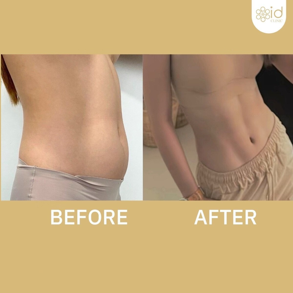 Before and after abdominal liposuction results at ID Clinic Bangkok, slimmer waistline achieved