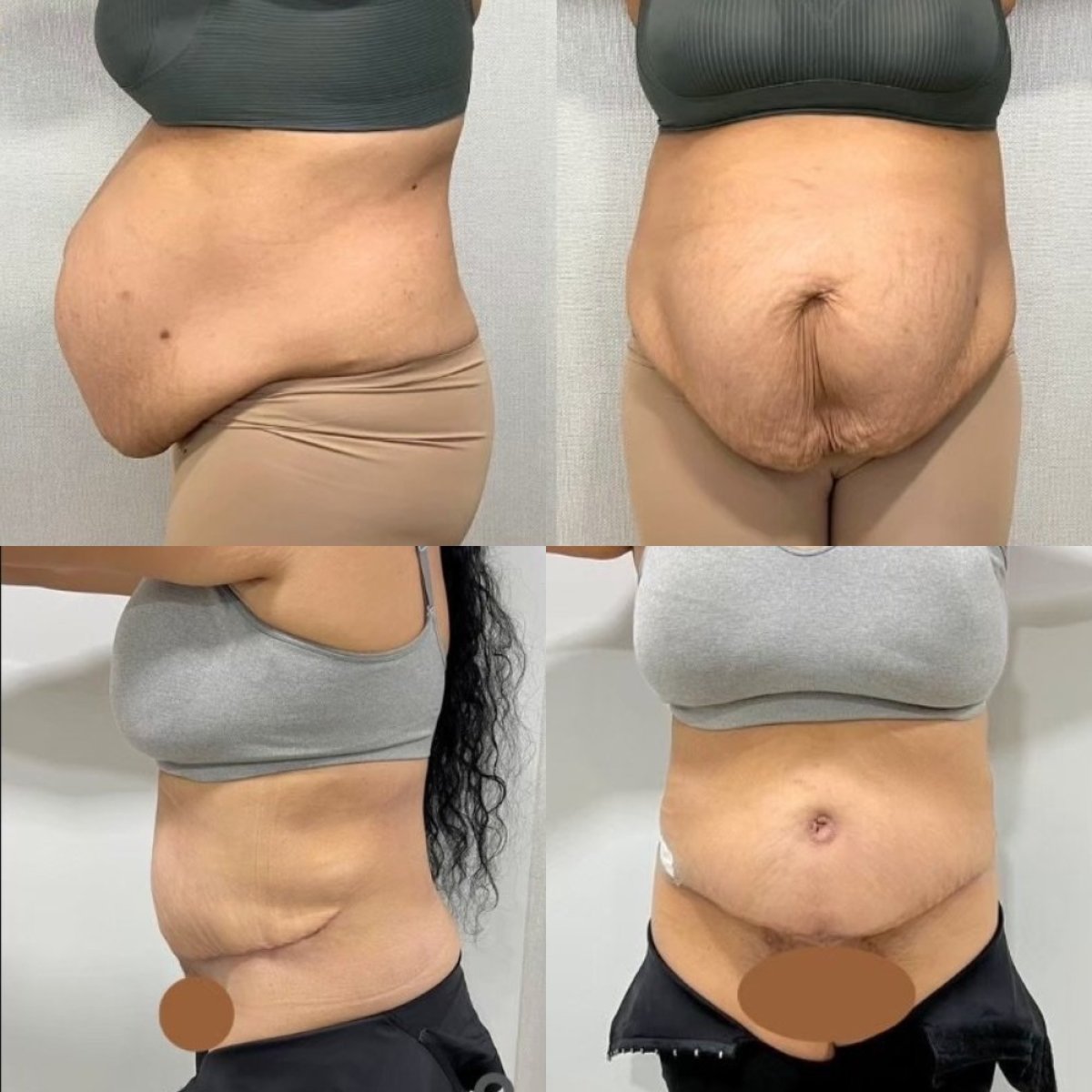 Before and after tummy tuck results at ID Clinic Bangkok, visible abdominal contour improvement