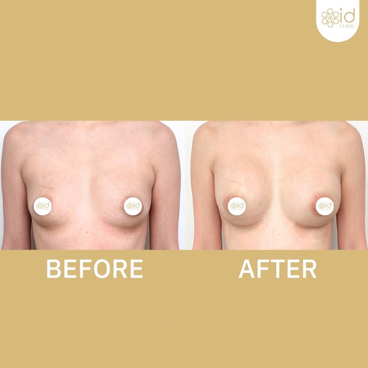 Before and after breast augmentation results at ID Clinic Bangkok, enhanced breast shape
