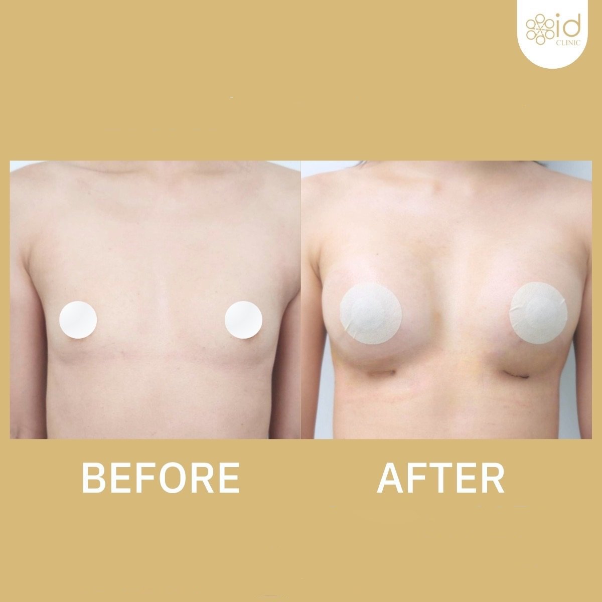 Before and after breast augmentation results at ID Clinic Bangkok, enhanced breast volume