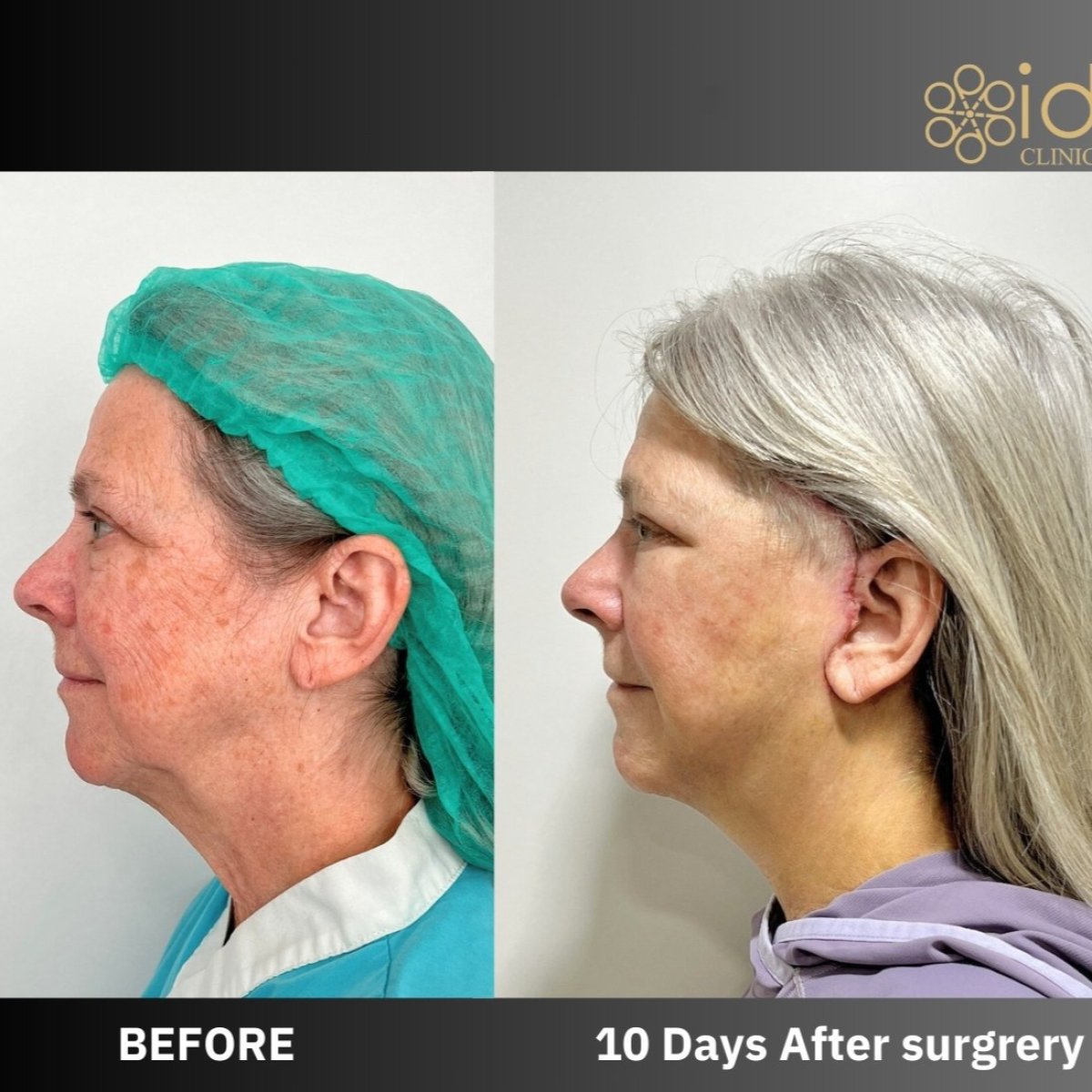 Résultats lifting endoscopique visage avant/après à ID Clinic Bangkok, rajeunissement visible