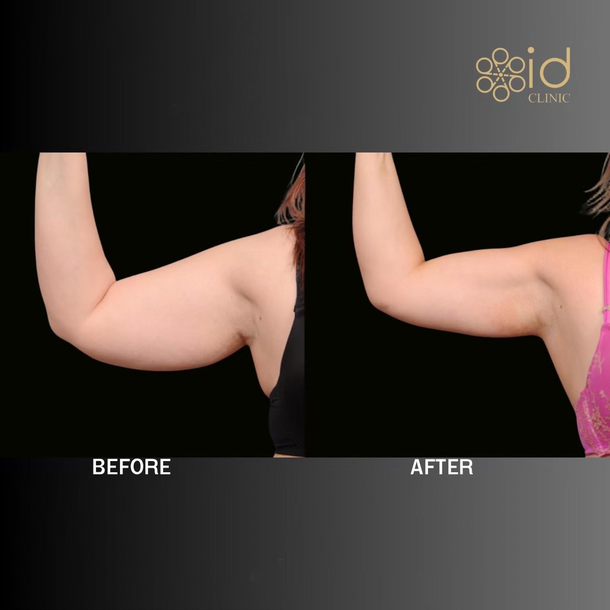 Before and after Vaser liposuction arm contouring results at ID Clinic Bangkok