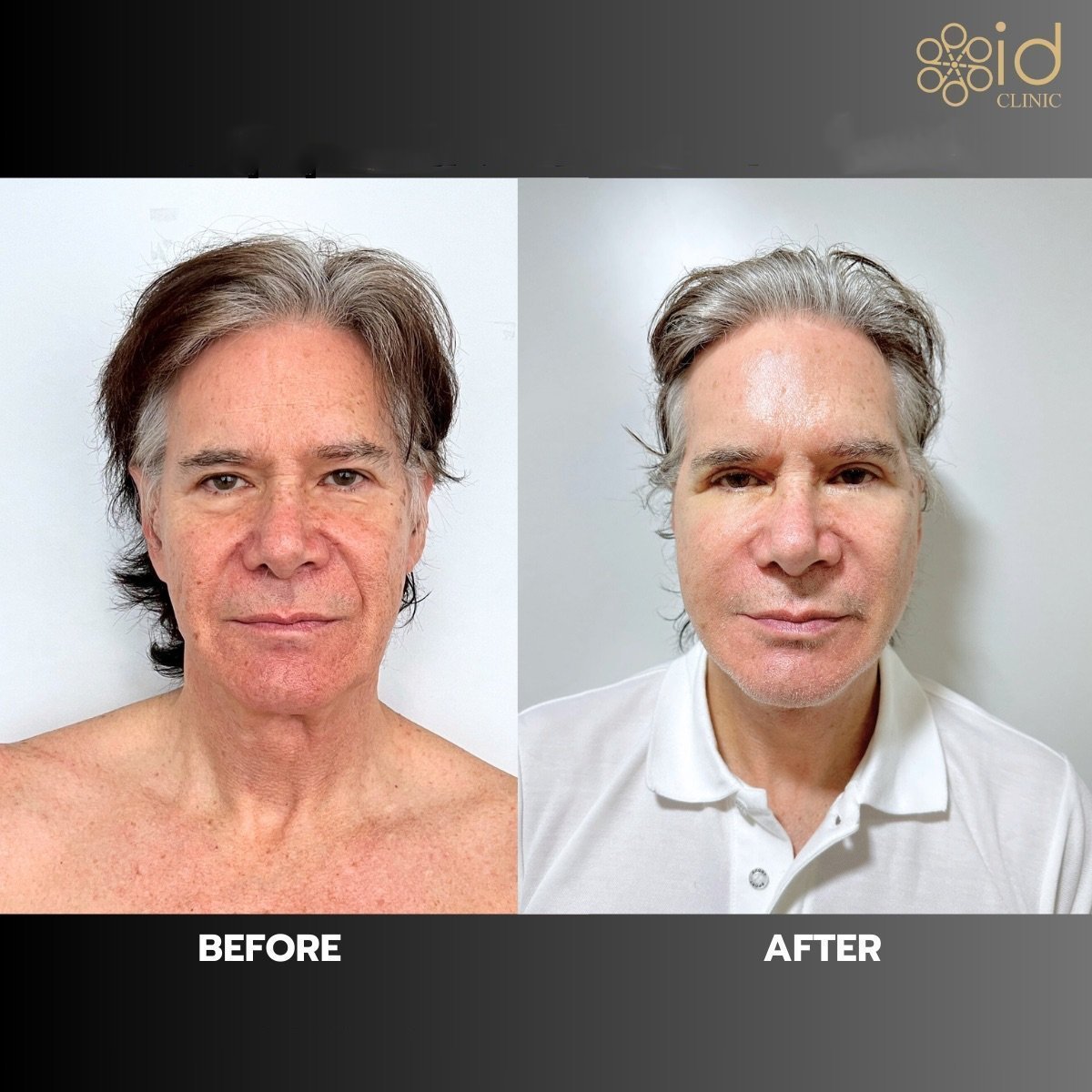 Before and after lower eyelid blepharoplasty results at ID Clinic Bangkok, rejuvenated appearance