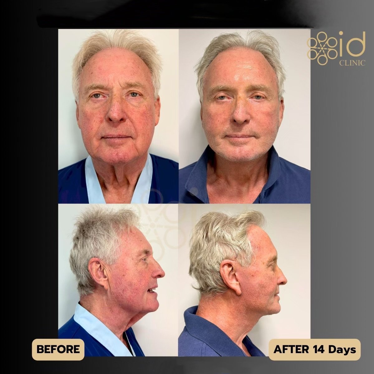 Before and after lower eyelid blepharoplasty results at ID Clinic Bangkok, 14 days post-op