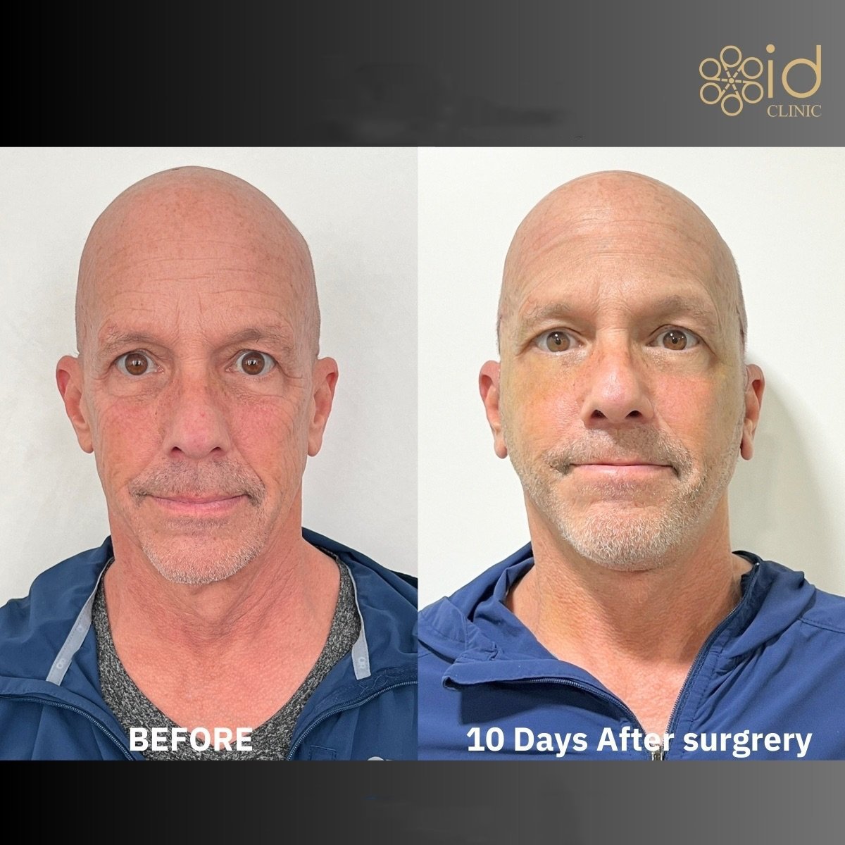 Lower eyelid blepharoplasty before and after results at ID Clinic Bangkok, 10 days post-op