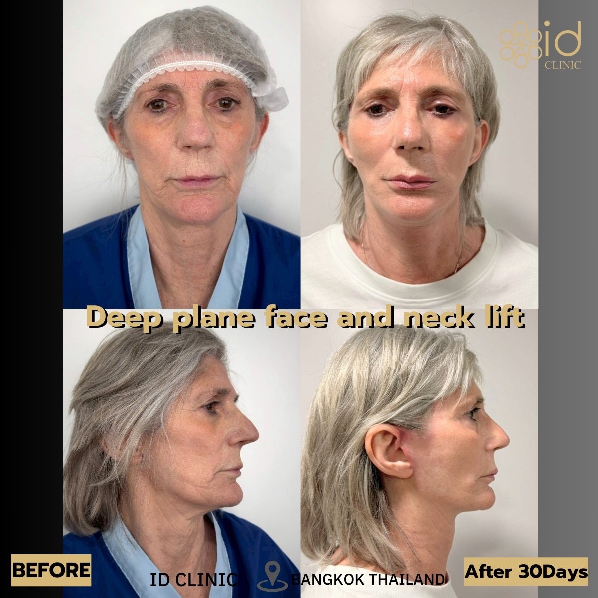 Before and after deep plane face and neck lift results at ID Clinic Bangkok, 30 days post-op