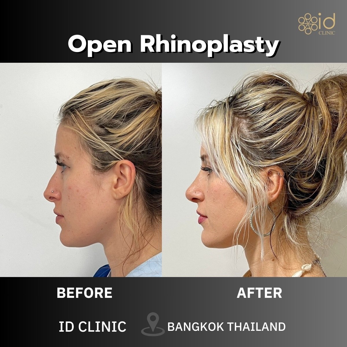 Resultados antes y después de rinoplastia abierta en ID Clinic Bangkok, mejora de la nariz