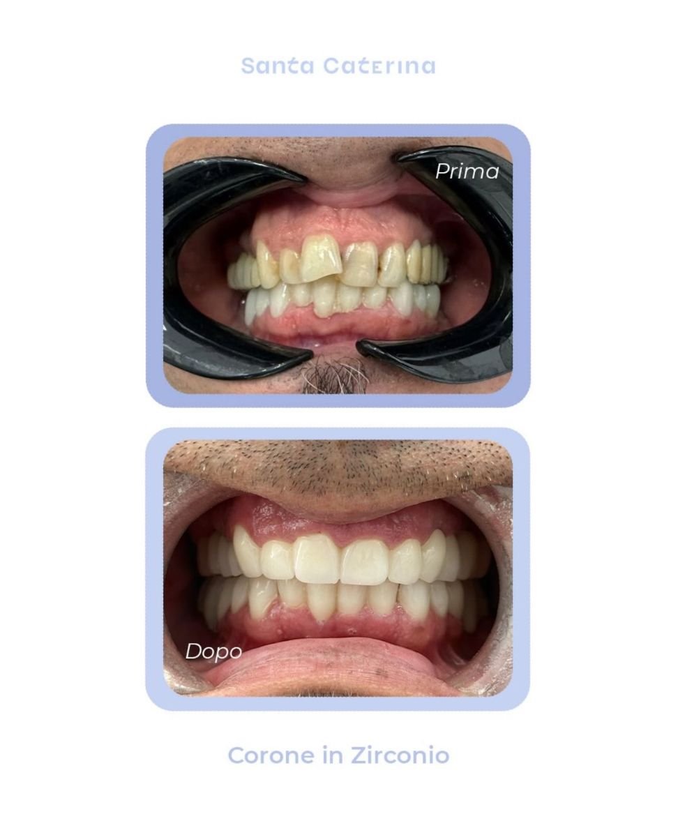 Avant et après couronnes en zircon chez Santa Caterina Clinic Dental & Aesthetic Medicine, résultat sourire