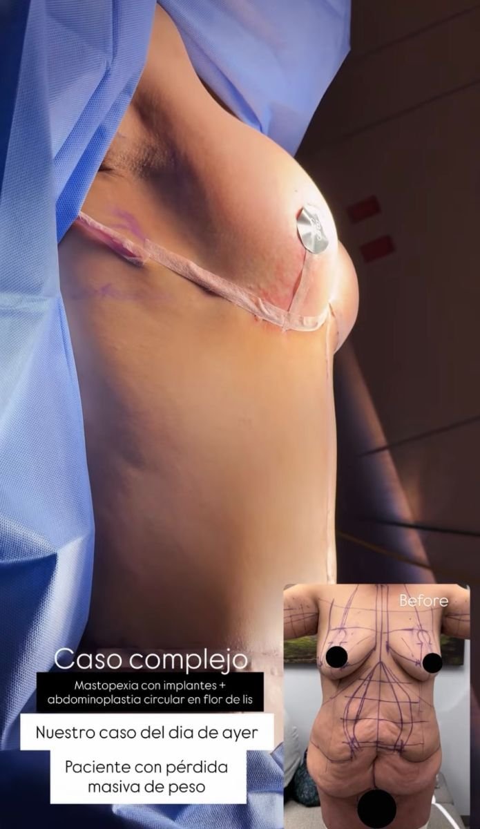 Результаты до и после подтяжки груди и абдоминопластики в Lucio Santos Plastic Surgery