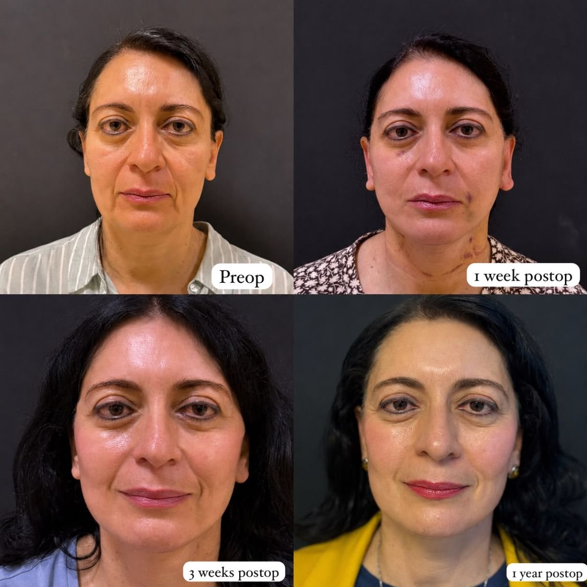 نتائج شد الوجه العميق قبل وبعد في Lucio Santos Plastic Surgery، تجديد شباب الوجه