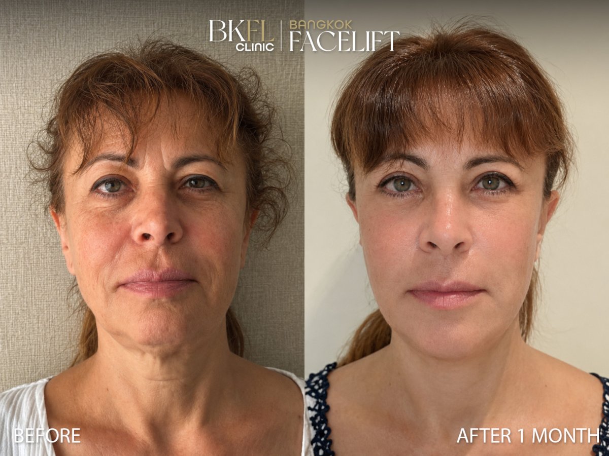 Before and after deep plane facelift results at BKFL Clinic – visible facial rejuvenation
