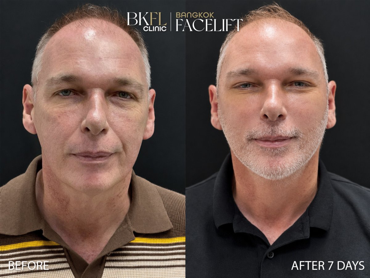 Before and after deep plane facelift results at BKFL Clinic – visible facial rejuvenation