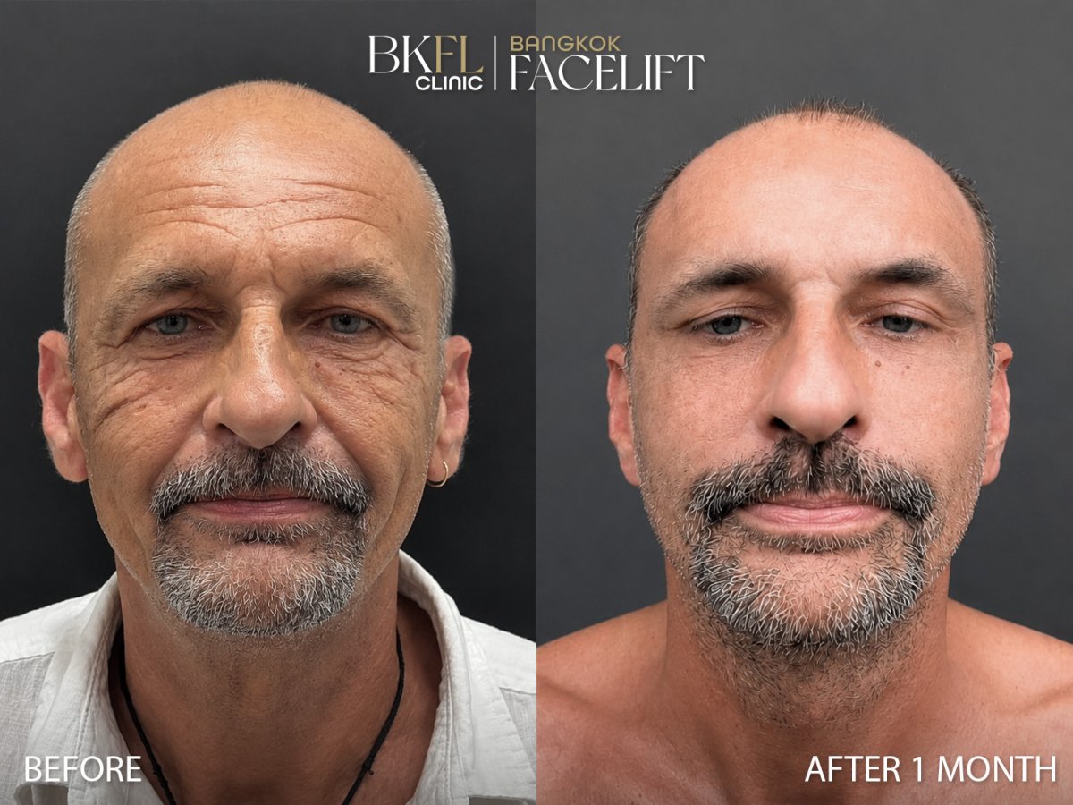 Deep plane facelift before and after results at BKFL Clinic – visible facial rejuvenation