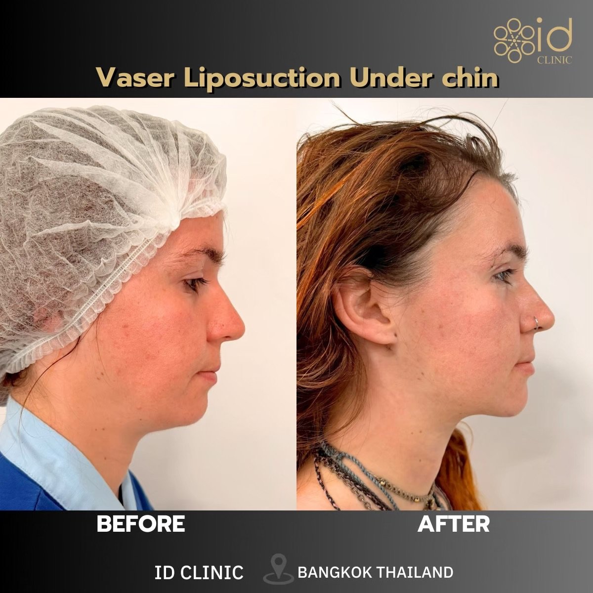 Before and after Vaser liposuction under chin at ID Clinic Bangkok, visible jawline result