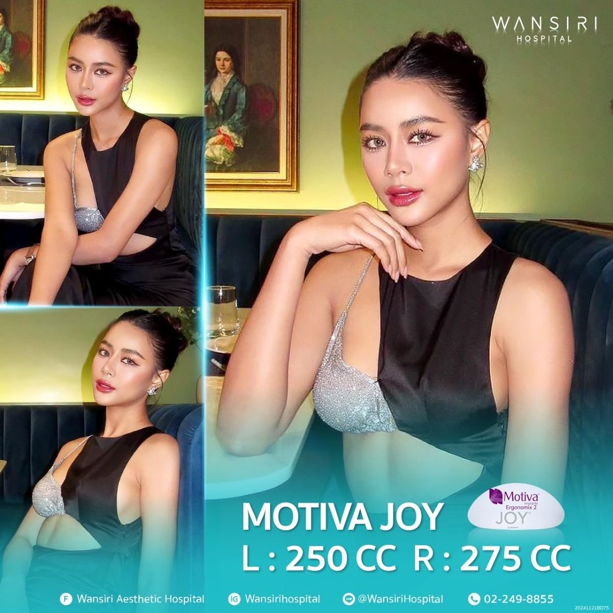 Увеличение груди имплантами Motiva Joy в Wansiri Hospital, результат 250cc и 275cc