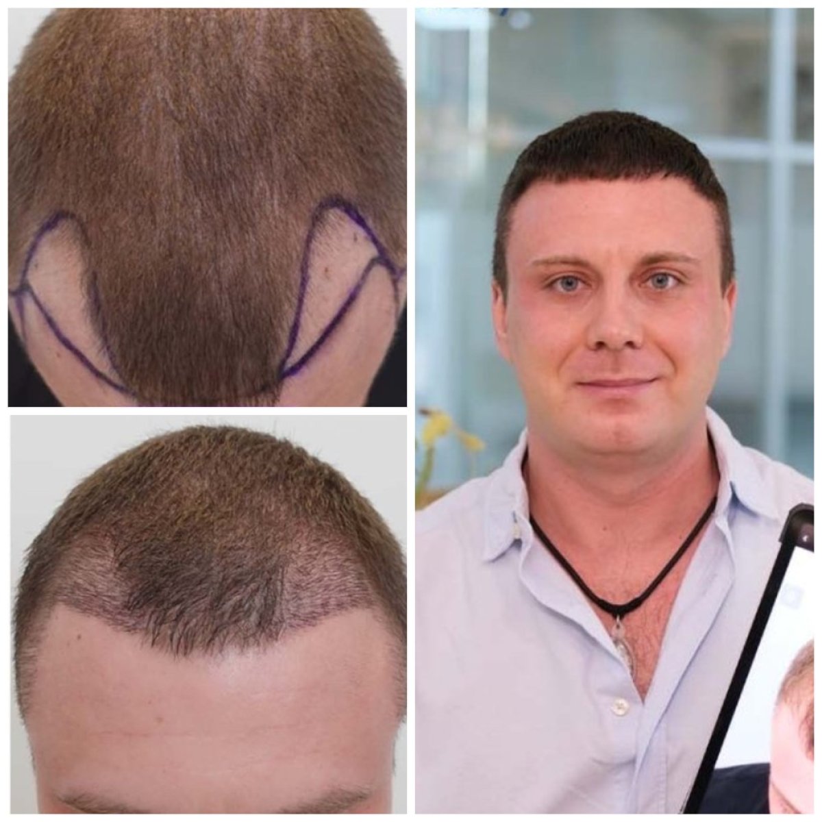 Vorher-nachher-Ergebnisse der Haartransplantation in Department of Skin & Surgery - NAVAMIN9 HOSPITAL
