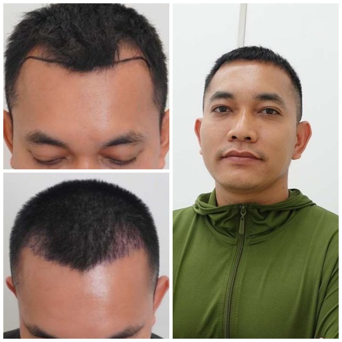 Resultados de trasplante capilar antes y después en Department of Skin & Surgery - NAVAMIN9 HOSPITAL