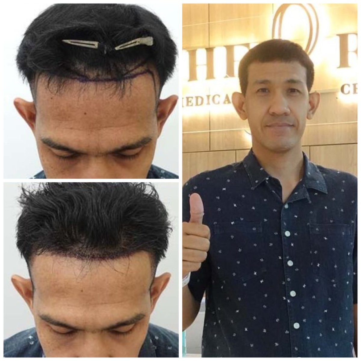 Vorher-nachher-Ergebnisse der Haartransplantation in Department of Skin & Surgery - NAVAMIN9 HOSPITAL