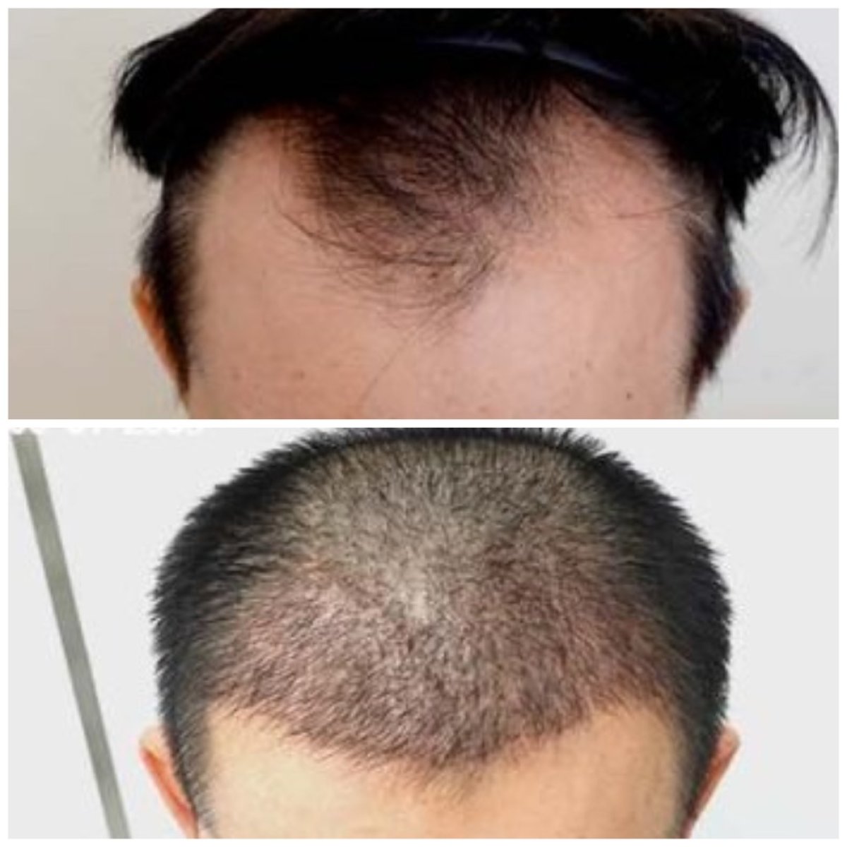 نتائج زراعة الشعر قبل وبعد في قسم الجلدية والجراحة - مستشفى نافامين9