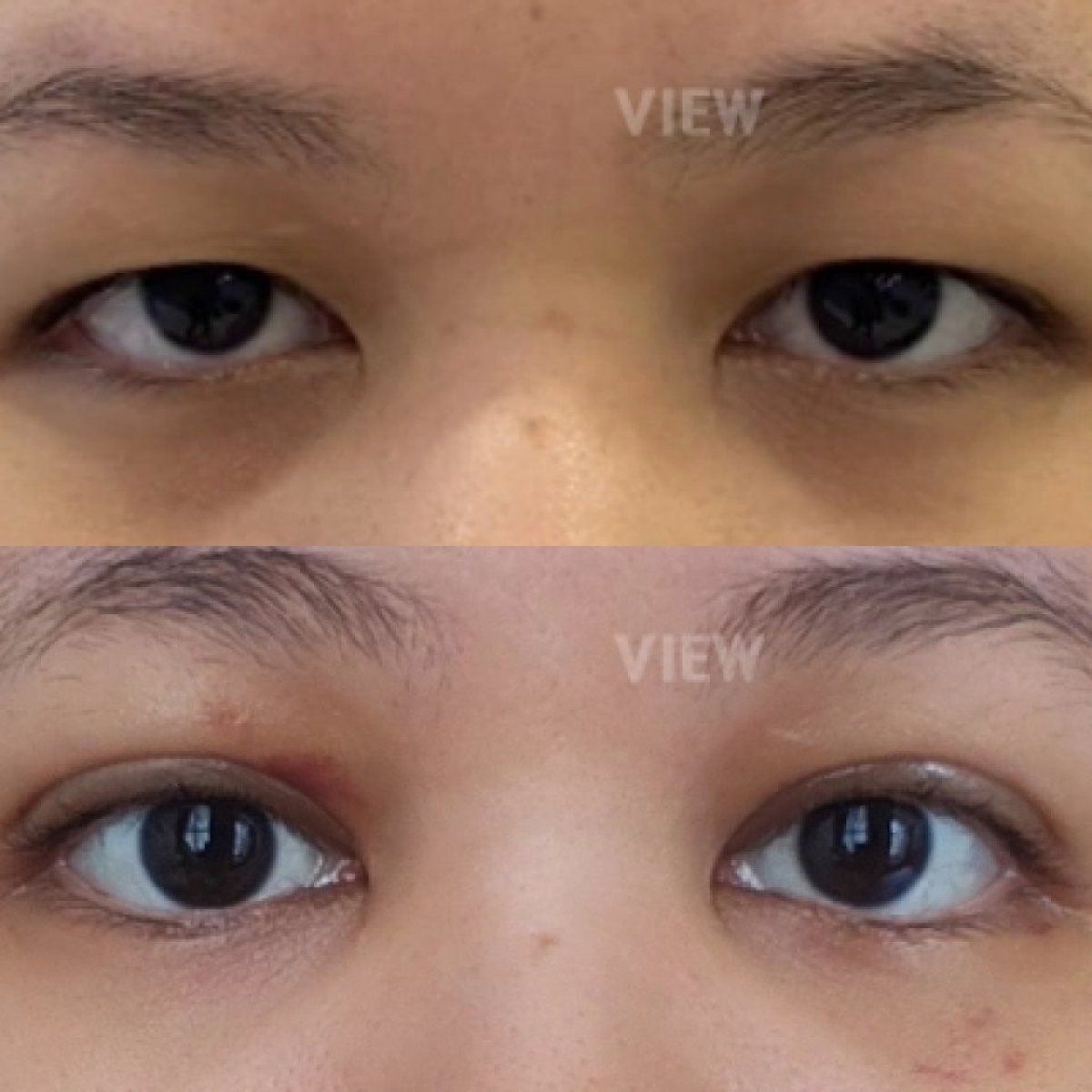 Lower eyelid blepharoplasty before and after results at View Plastic Surgery Hospital