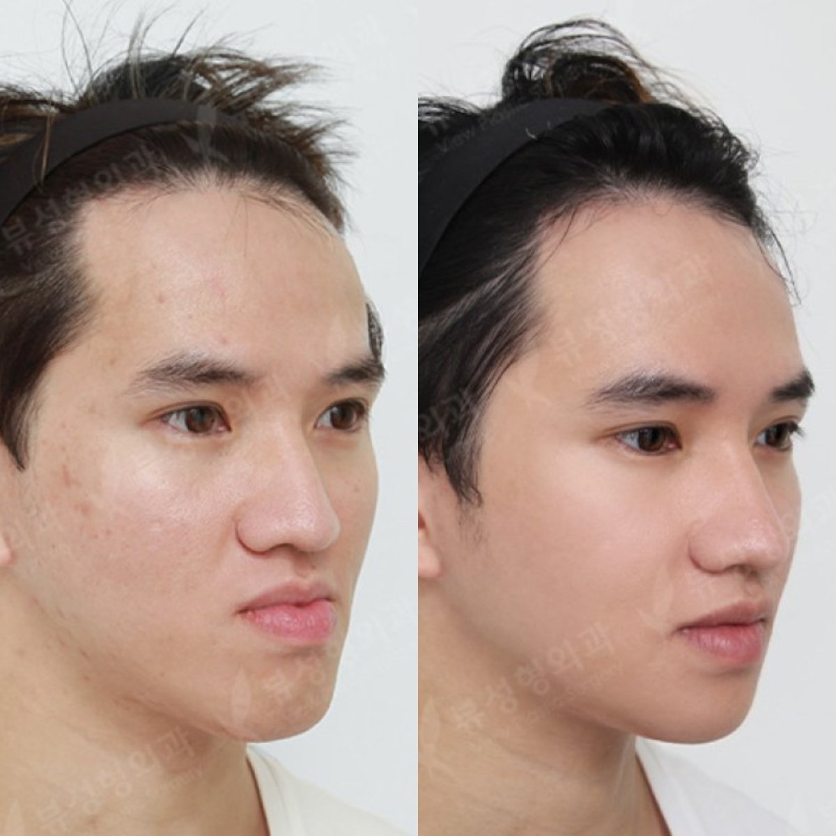 نتائج قبل وبعد جراحة الفكين في مستشفى View Plastic Surgery، تحسين خط الفك