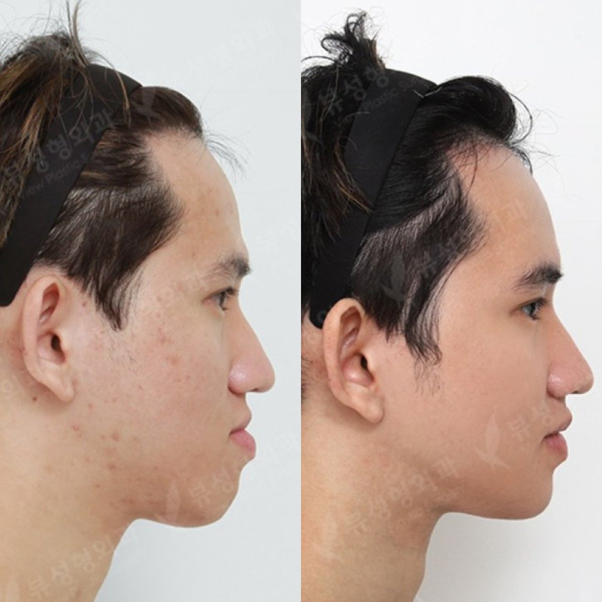 نتائج قبل وبعد جراحة الفكين في مستشفى View Plastic Surgery، تصحيح الفك