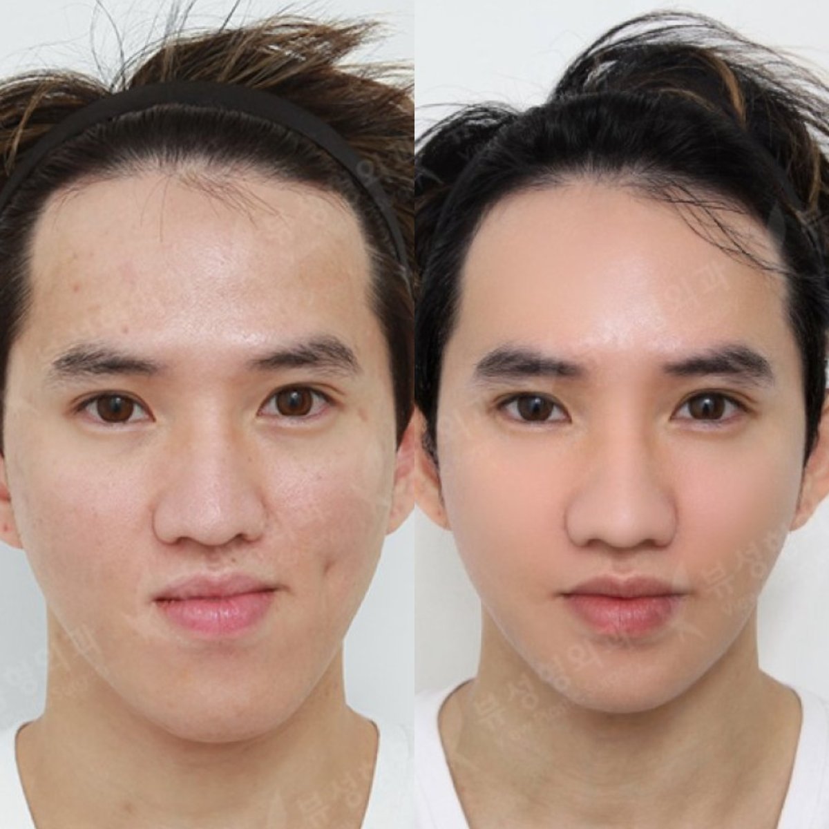 نتائج قبل وبعد جراحة الفكين في مستشفى View Plastic Surgery، تحسين ملامح الوجه