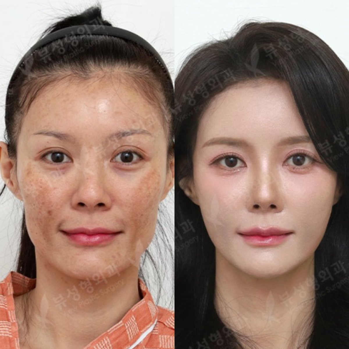 Before and after lipofilling results at View Plastic Surgery Hospital, facial rejuvenation