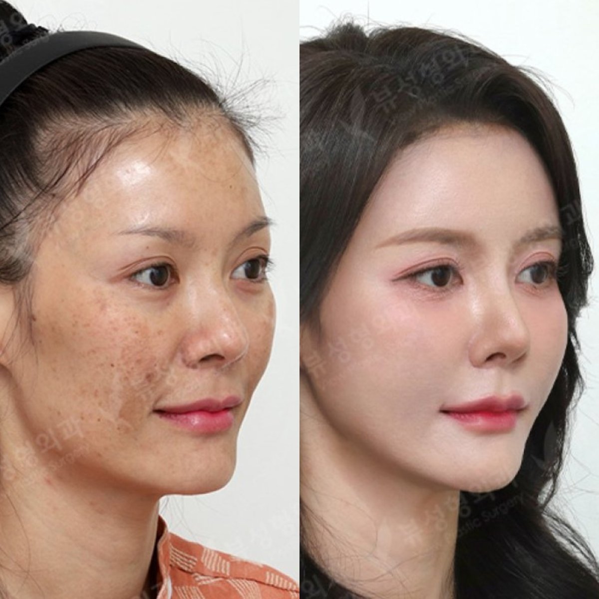 Resultados de lipofilling facial antes y después en View Plastic Surgery Hospital, restauración de volumen