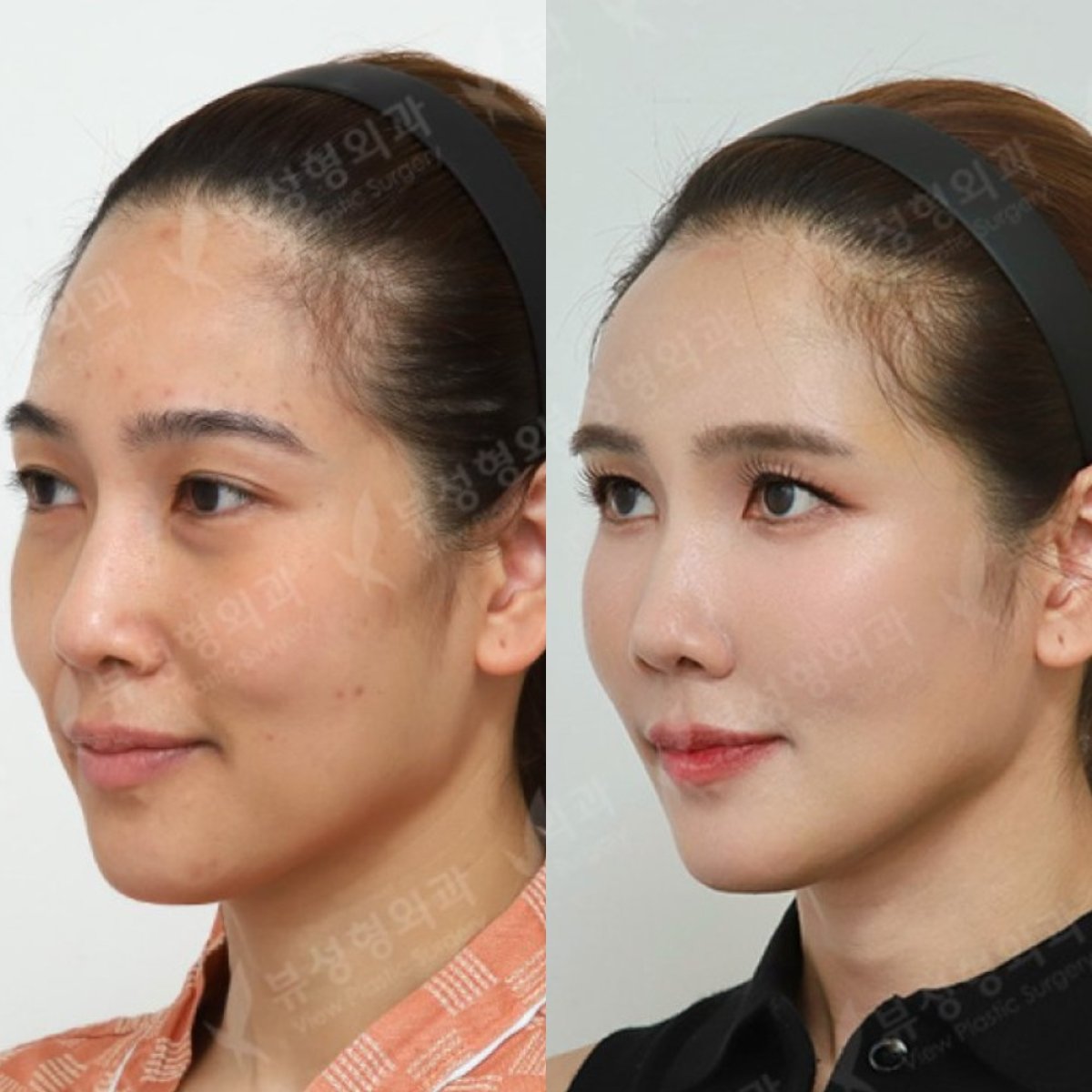Before and after lipofilling results at View Plastic Surgery Hospital, facial volume enhancement