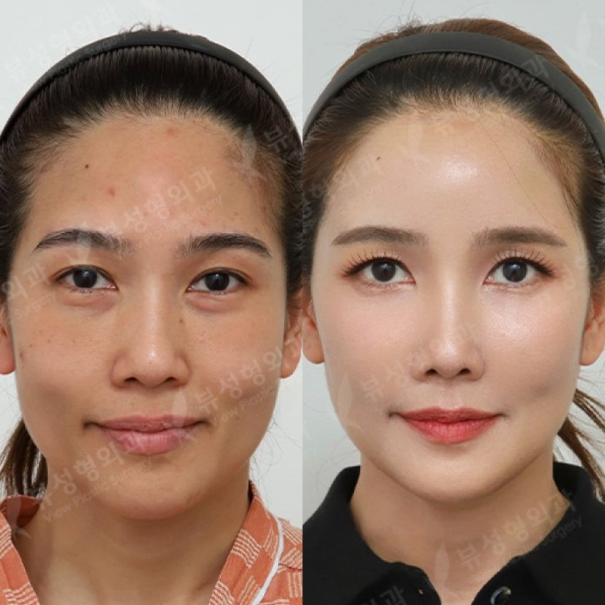 Before and after lipofilling results at View Plastic Surgery Hospital, facial volume enhancement