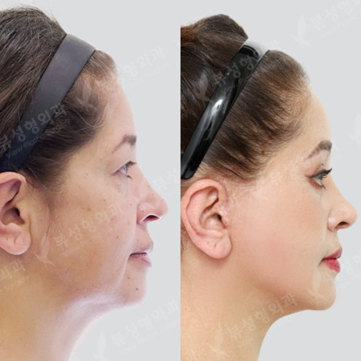 Resultados de lifting facial antes y después en View Plastic Surgery Hospital, rejuvenecimiento