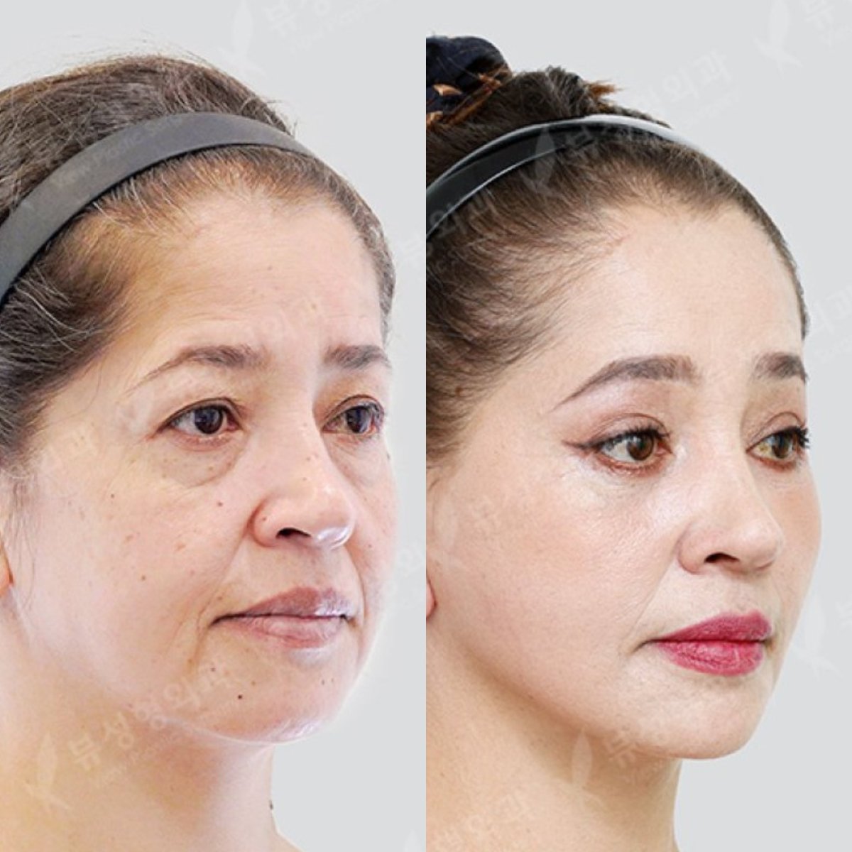 Resultados de lifting facial antes y después en View Plastic Surgery Hospital, rejuvenecimiento