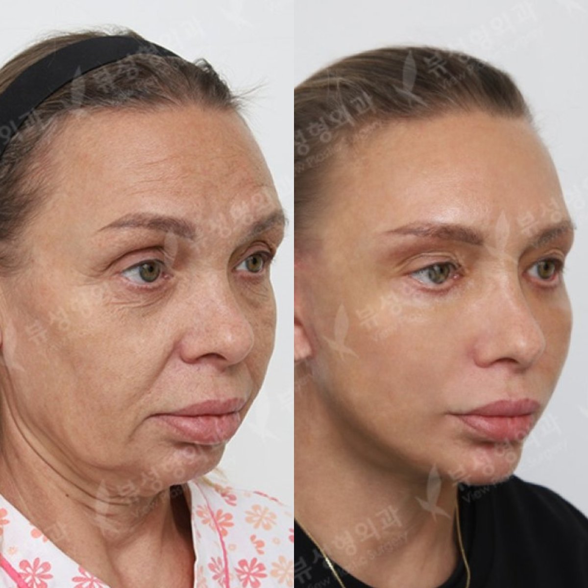 Vorher-nachher-Ergebnisse Facelift bei View Plastic Surgery Hospital, sichtbare Verjüngung