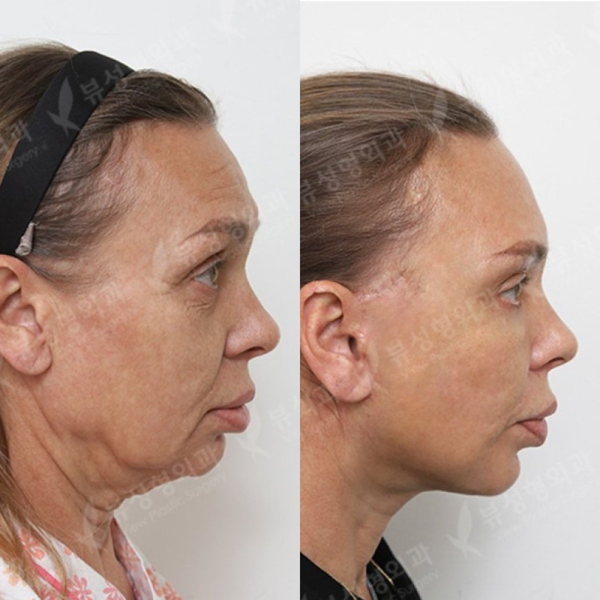 Before and after facelift results at View Plastic Surgery Hospital, visible facial rejuvenation
