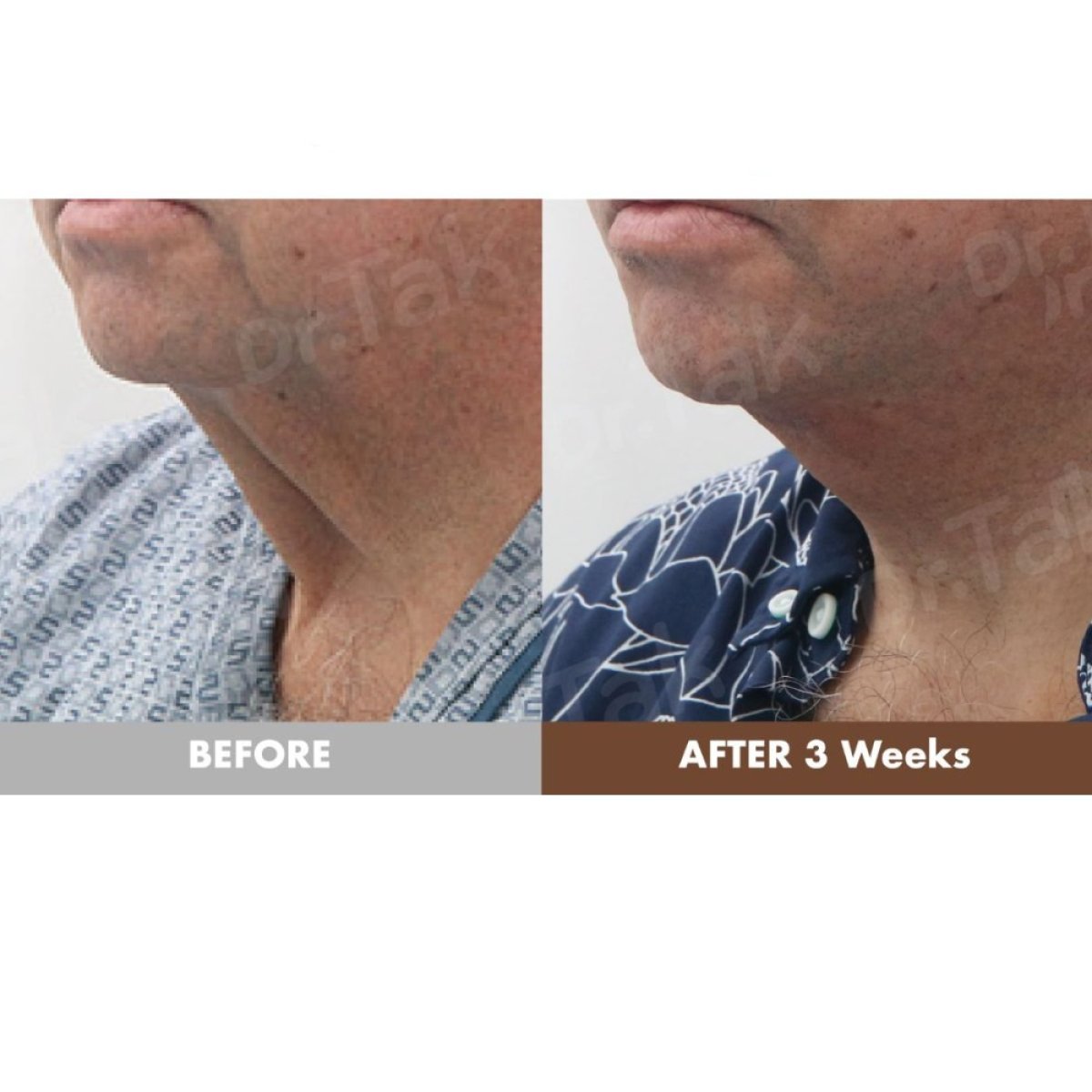 نتائج شد الوجه قبل وبعد في عيادة Dr. Tak Plastic Surgery – شد واضح للرقبة والفك