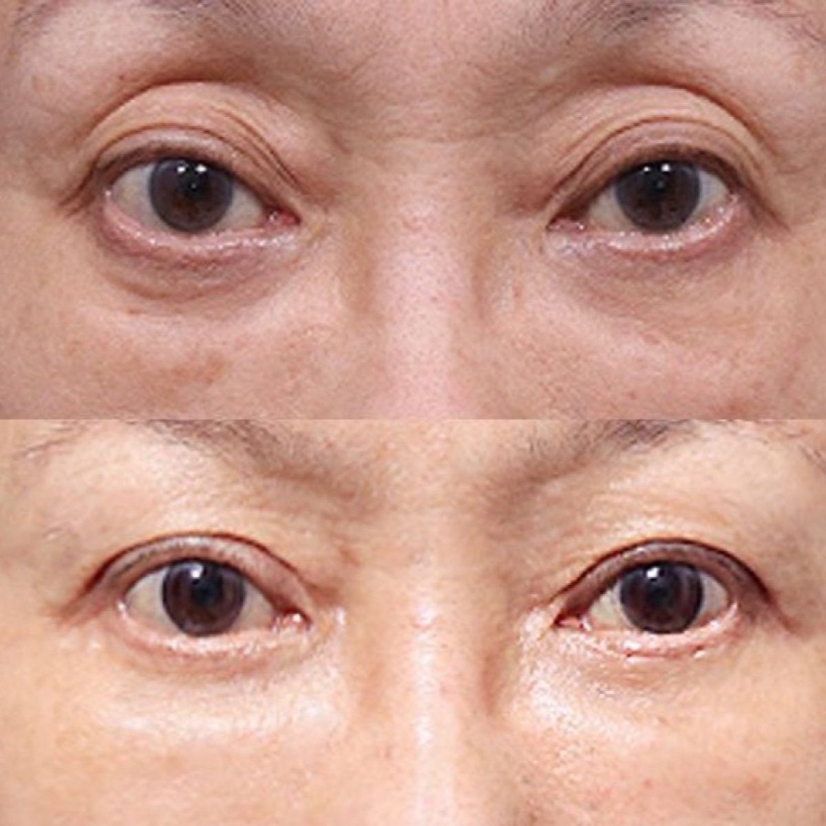 Before and after droopy eyelid surgery results at VG Plastic Surgery, improved eye appearance