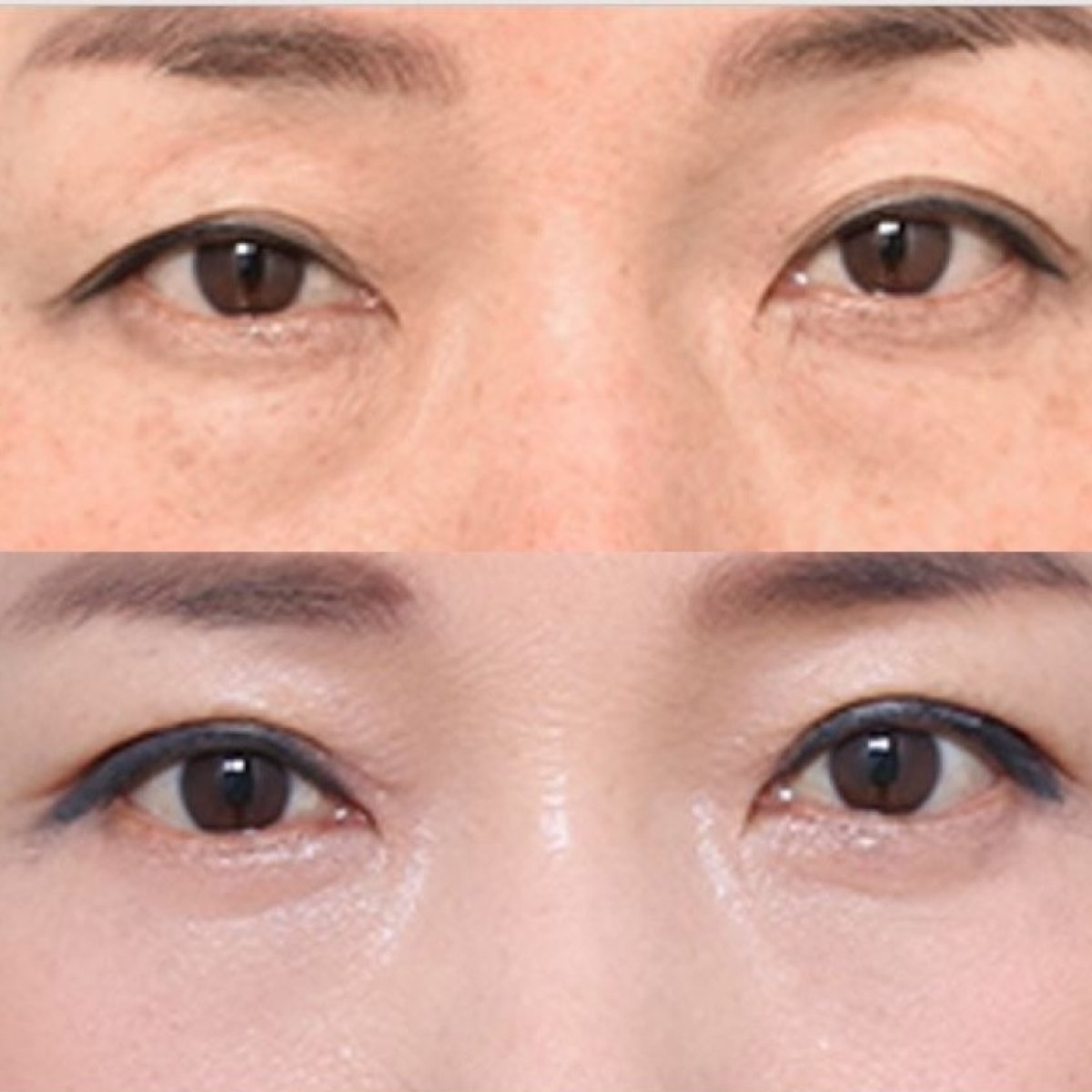 نتائج قبل وبعد جراحة الجفن المتدلي في VG Plastic Surgery، مظهر جفن محسّن