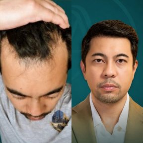 VIP DHI or FUE hair transplant All Included - photo 5