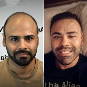 VIP DHI or FUE hair transplant All Included - photo 4