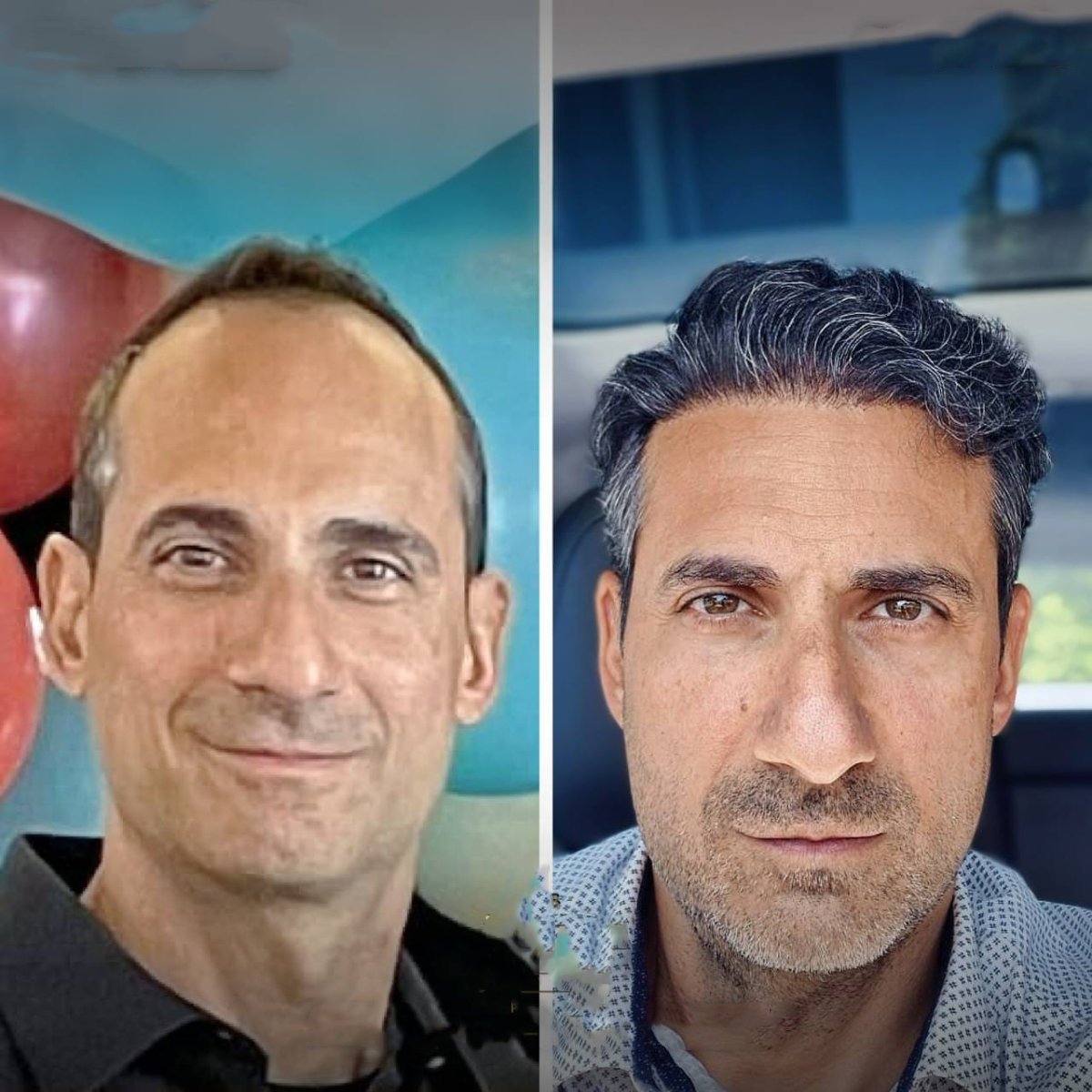 Resultados antes y después de trasplante capilar DHI en hombre – línea y densidad restauradas
