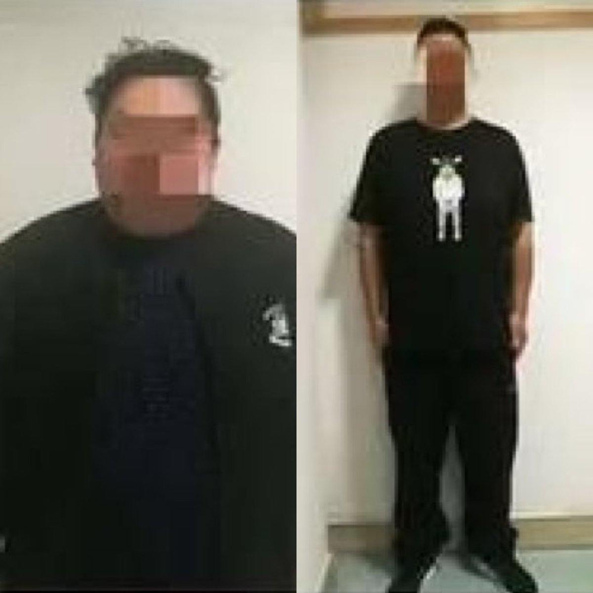نتائج قبل وبعد تكميم المعدة في مستشفى Xiamen Humanity، فقدان وزن ملحوظ