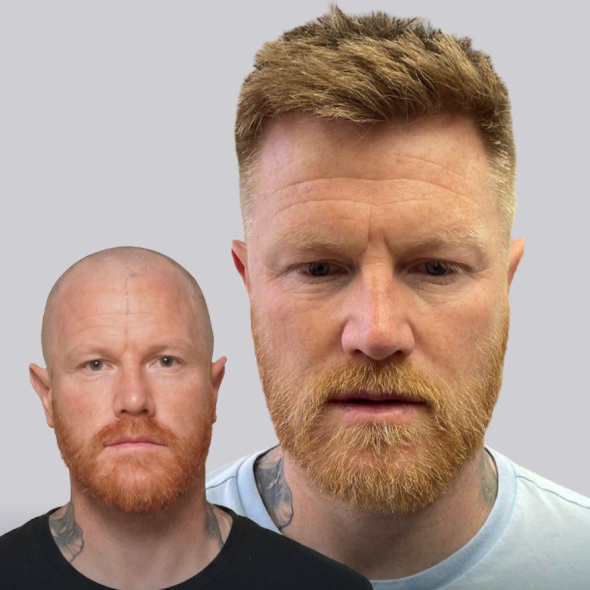 Before and after stem cell hair transplant results – restored hairline and fuller hair
