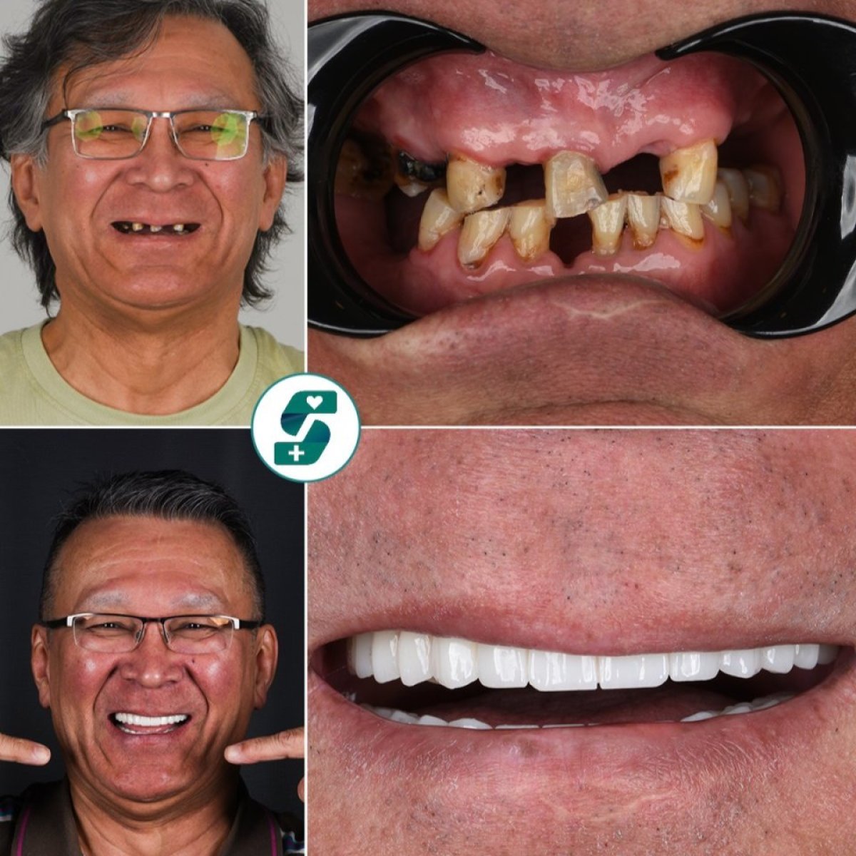 Before and after All-on-4 dental implants at Soraca Med – full smile restoration results