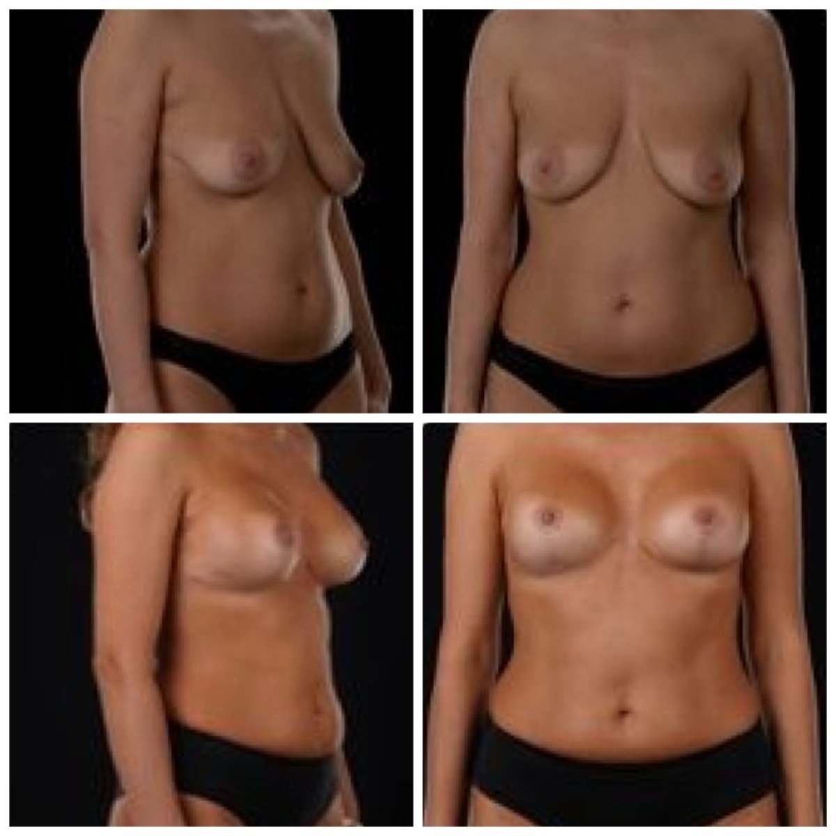 Résultats avant et après lifting mammaire chez Yurchenko Plastic Surgery Team, contour amélioré