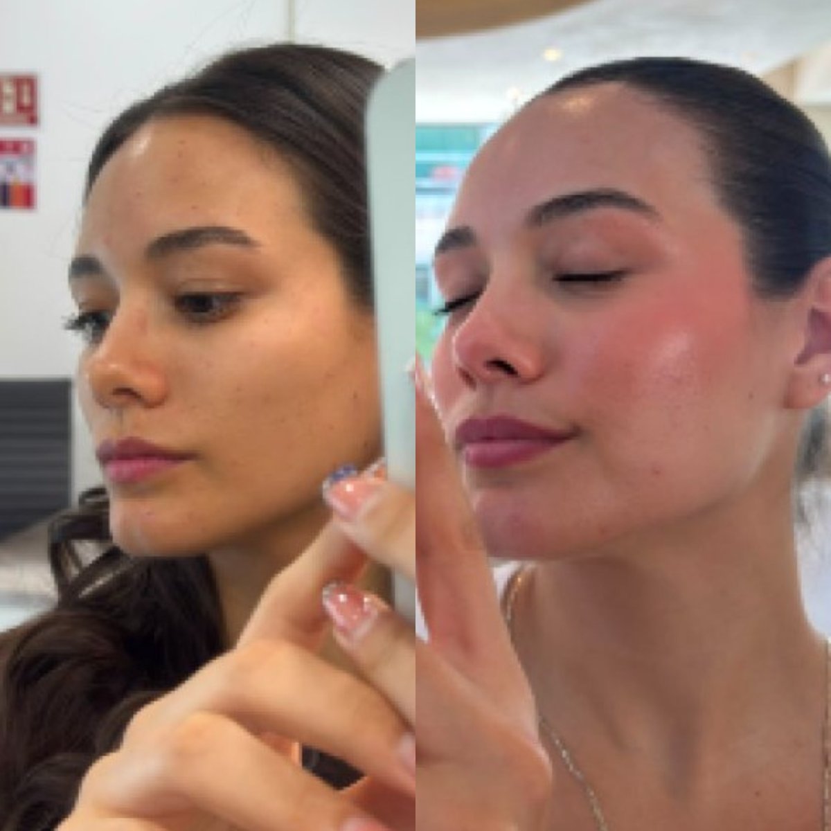 Before and after results of facial rejuvenation with donor stem cells – improved skin glow