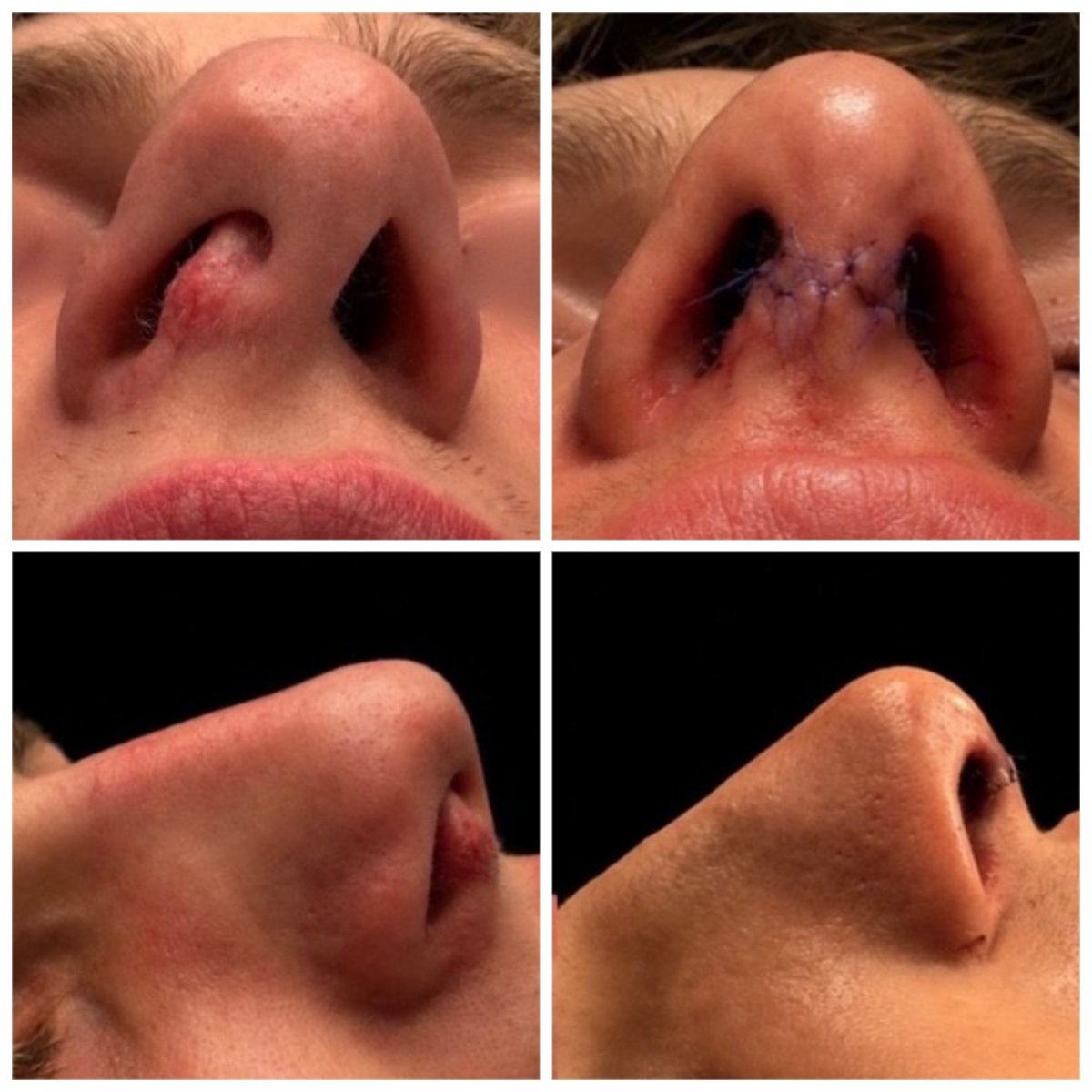 Resultados de rinoplastia antes y después en Klinika Promedion, mejor forma y simetría nasal