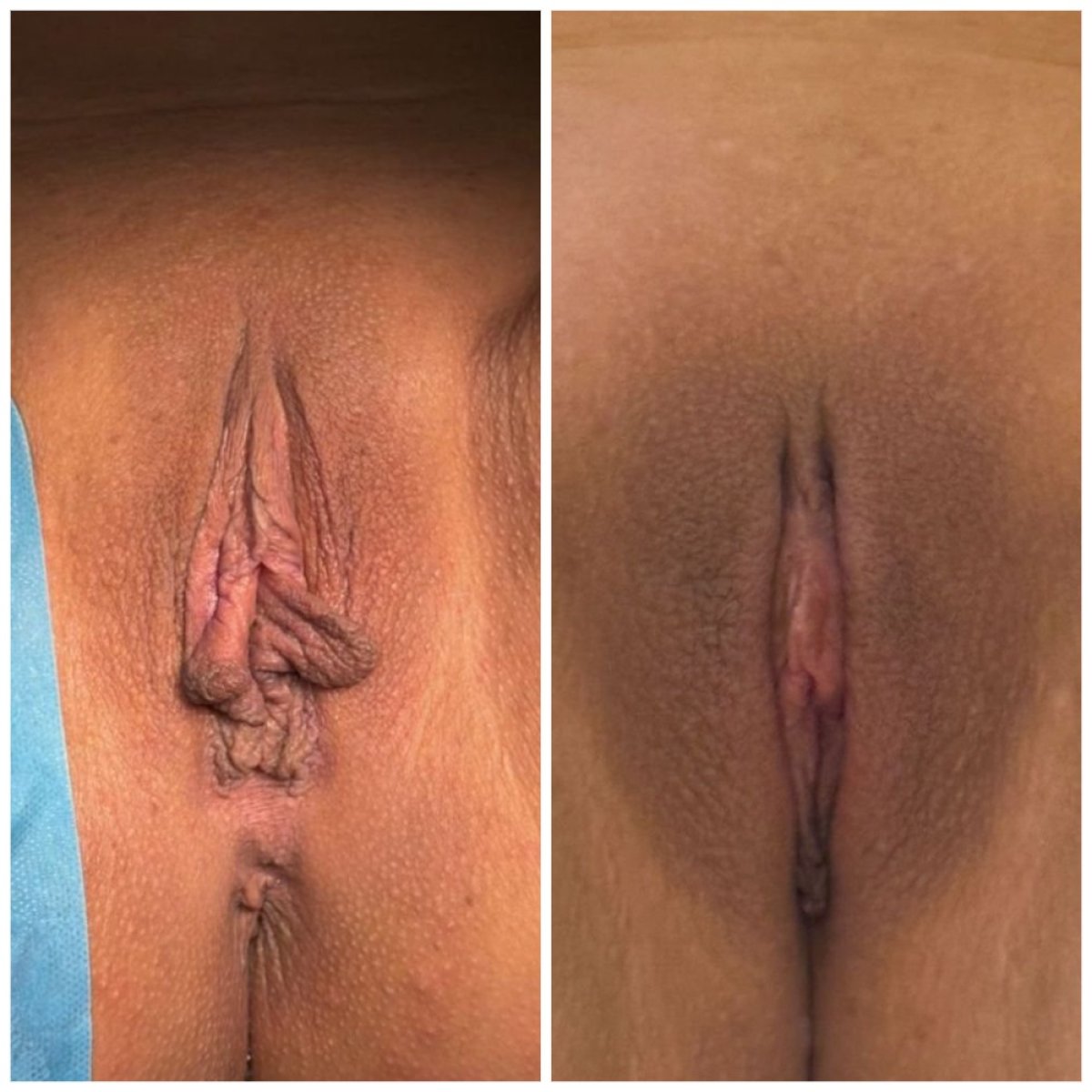 Before and after labiaplasty results at Assoc. Prof. Dr. Esra Özbaşlı OBGYN & Women Genital Aesthetics