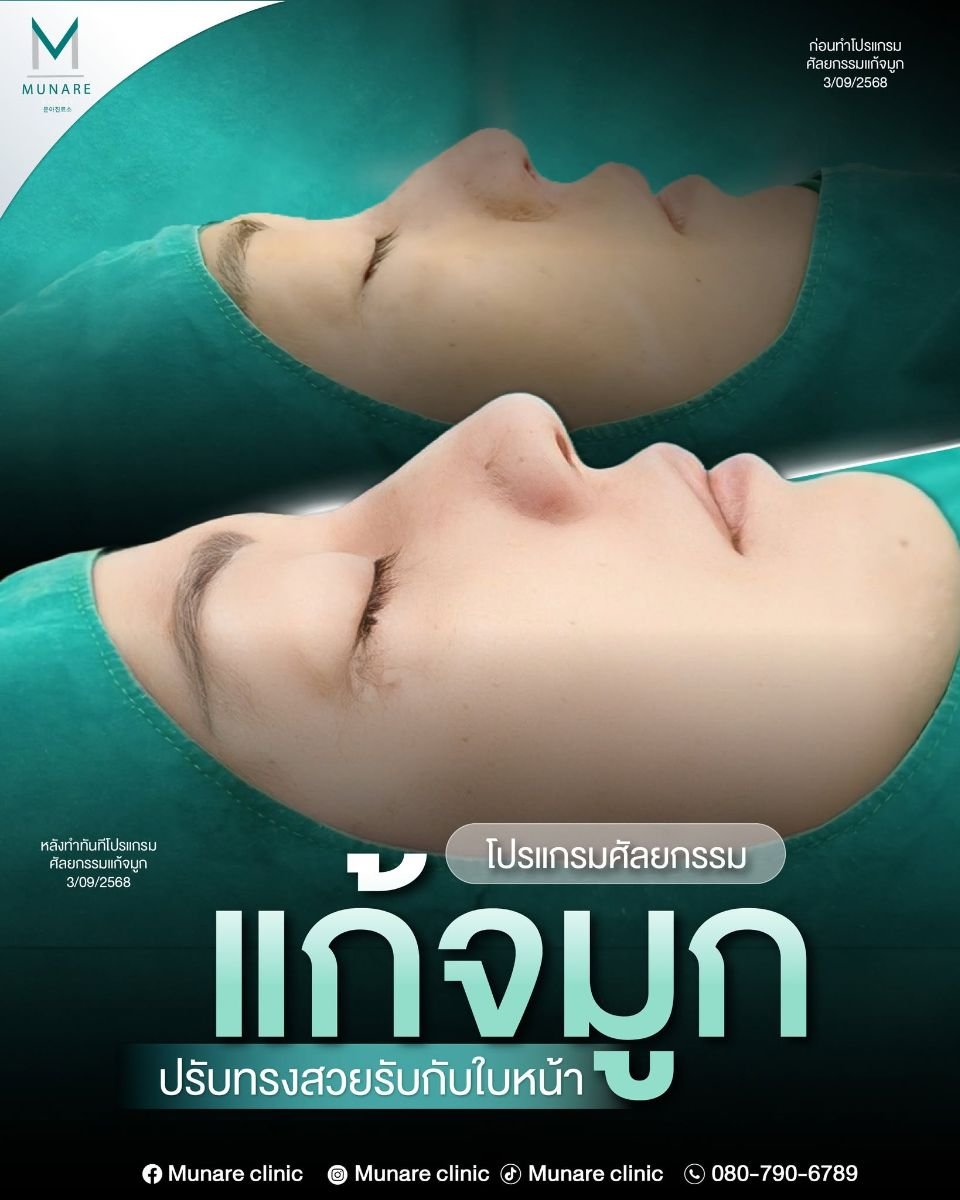Efekty przed i po rhinoplastyce w Munare Clinic Chiangmai, poprawiony profil nosa